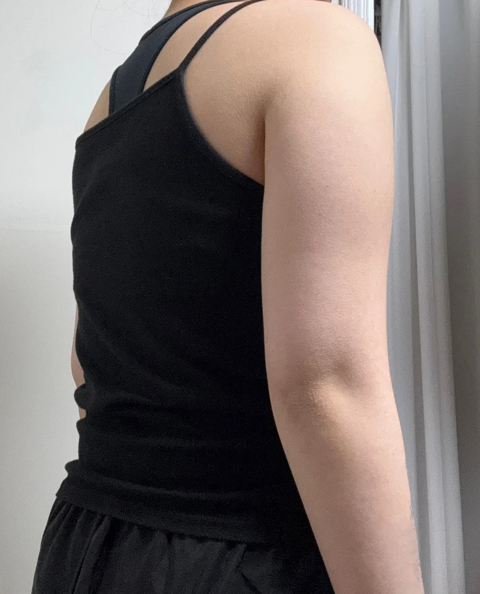 Arm liposuction, 6-month review - Arm Liposuction Before 2 - TheLINE Plastic Surgery