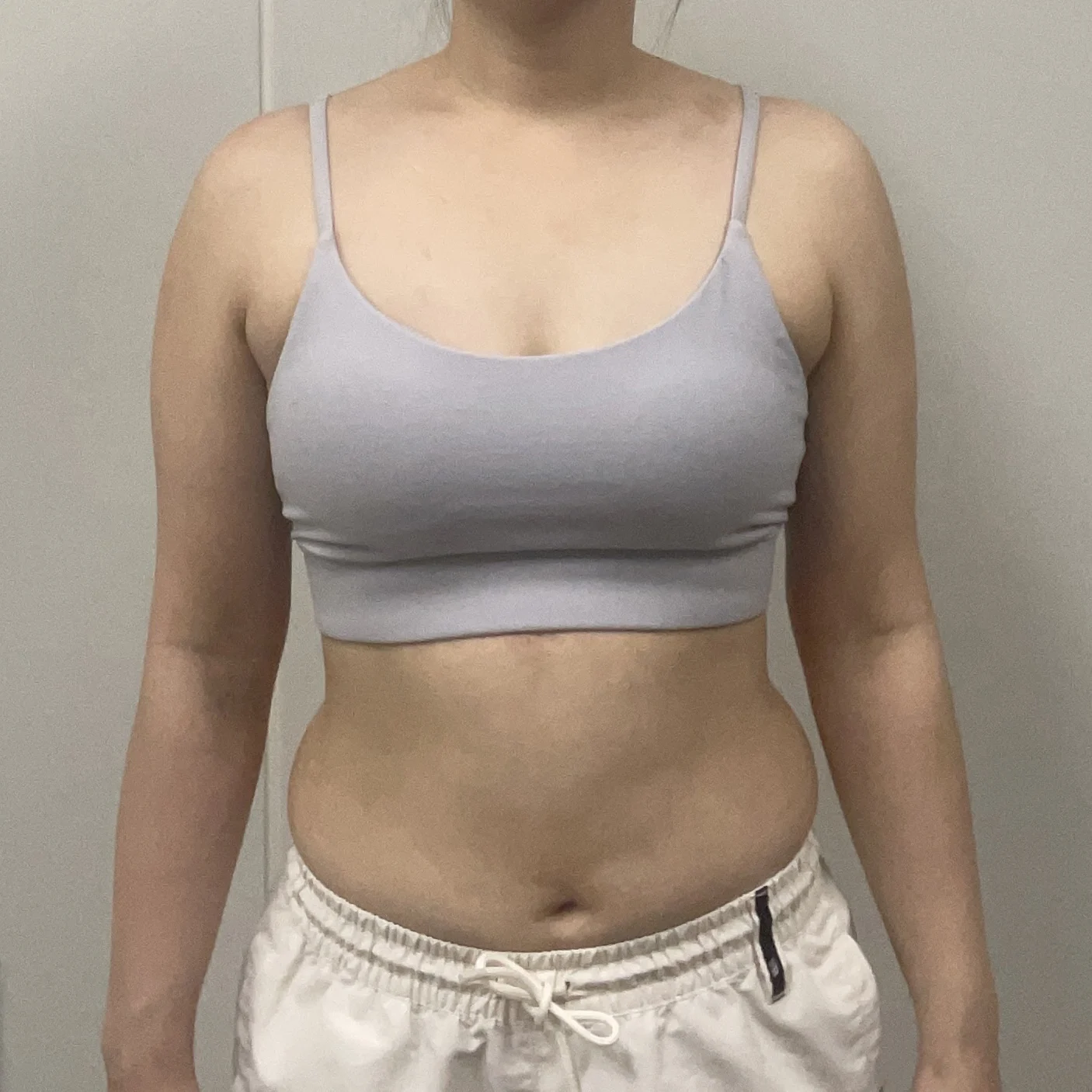 The 3-month mark is the real deal - Arm Liposuction Before 2 - TheLINE Plastic Surgery