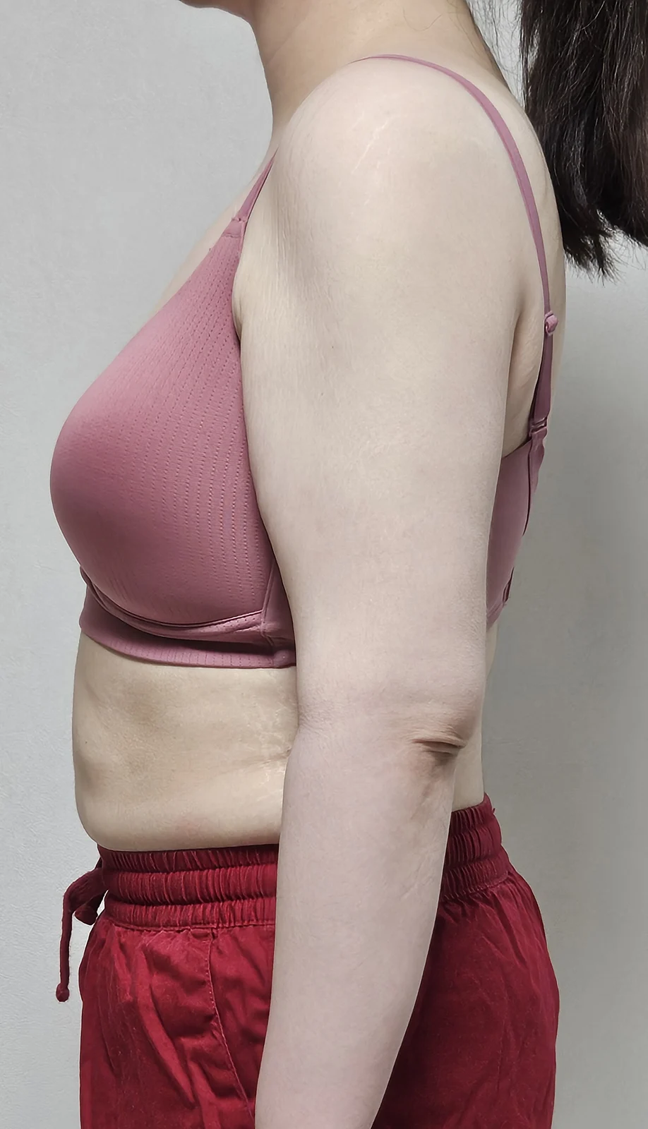 So glad I had the arm lift - Body Contouring surgery Before photo - TheLINE Plastic Surgery