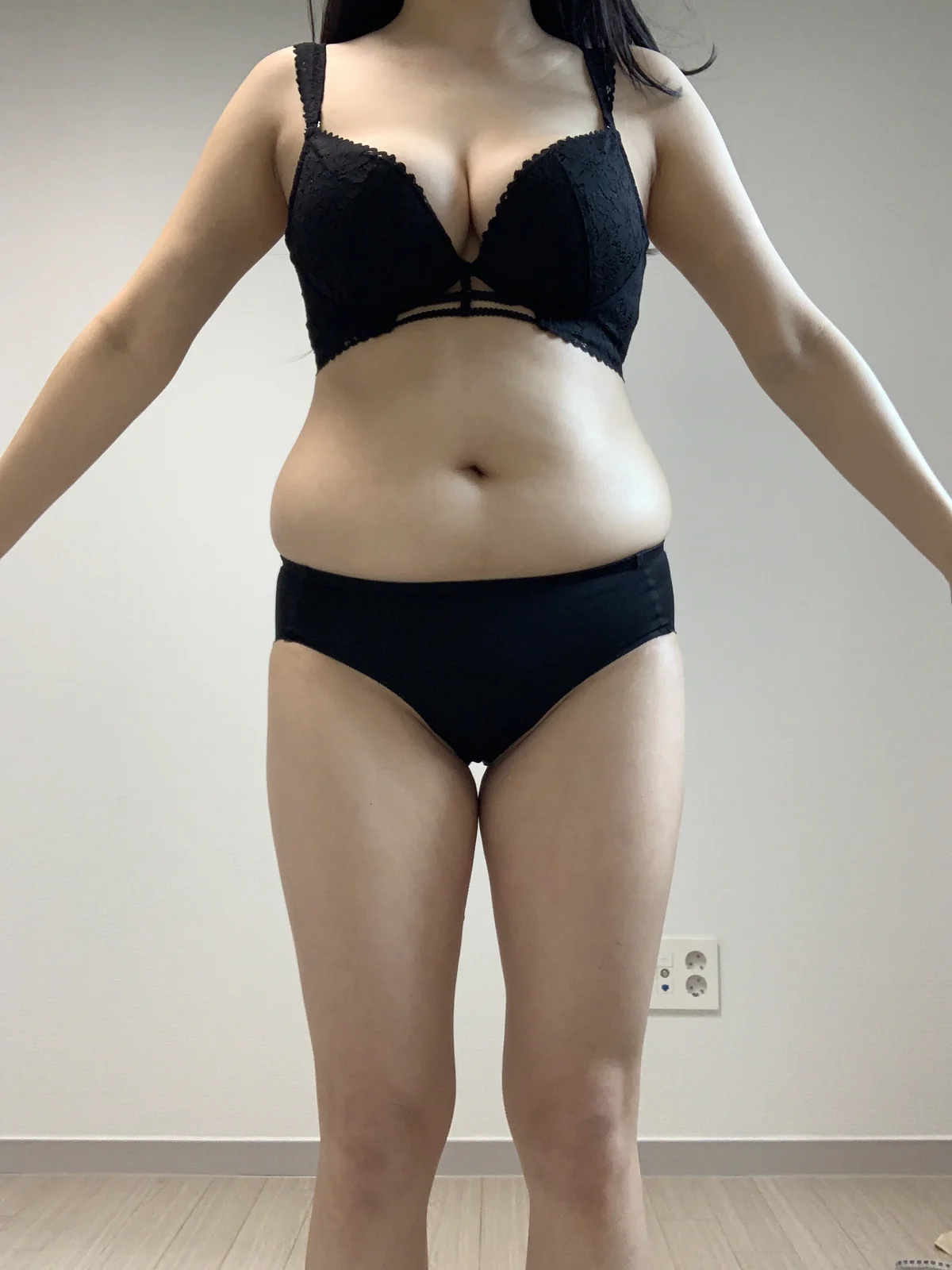 Waist to saddlebags review!! - Hip Fat Grafting Before 2 - TheLINE Plastic Surgery