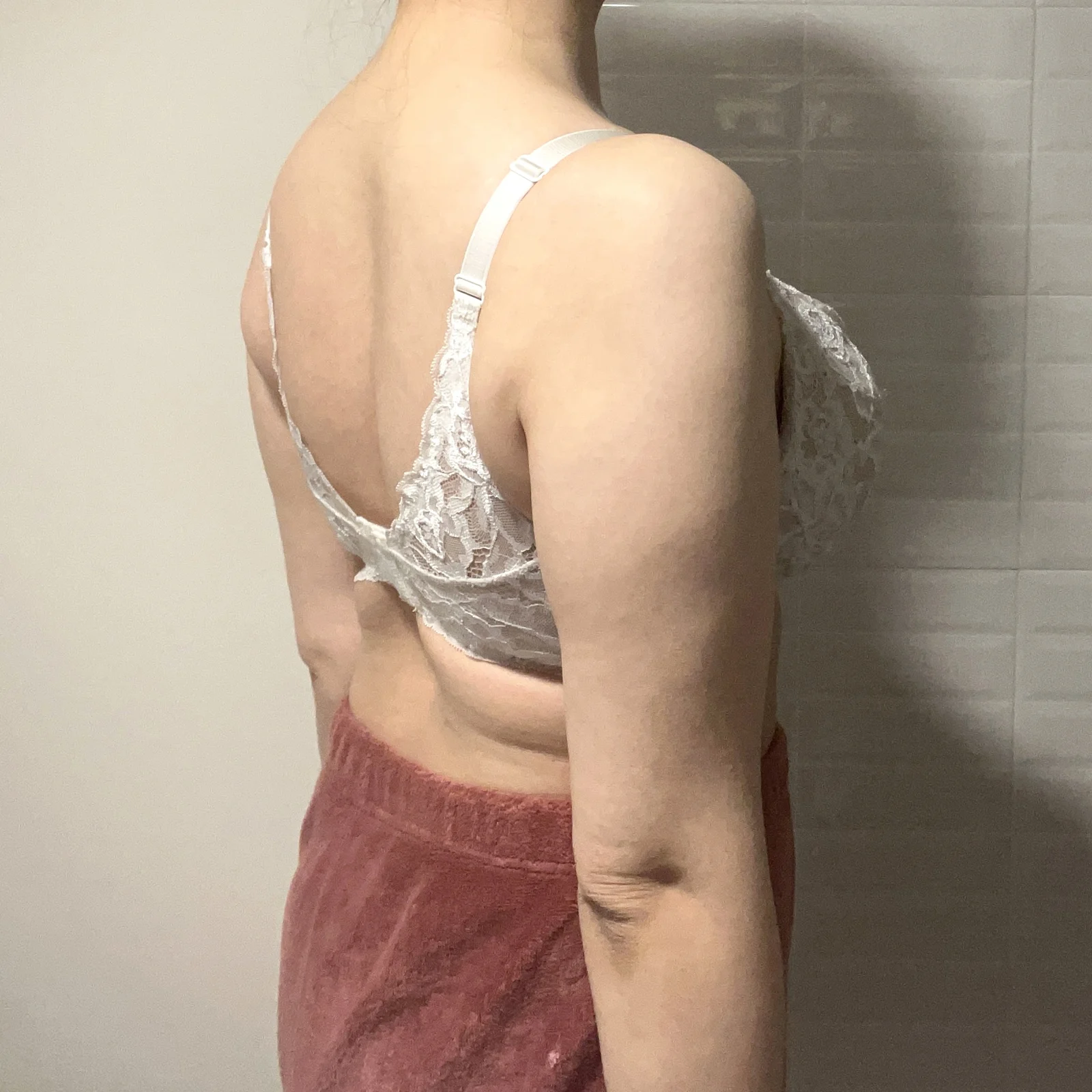 Upper body liposuction, 6 months in! - Abdominal Liposuction (Upper Body) Before 2 - TheLINE Plastic Surgery