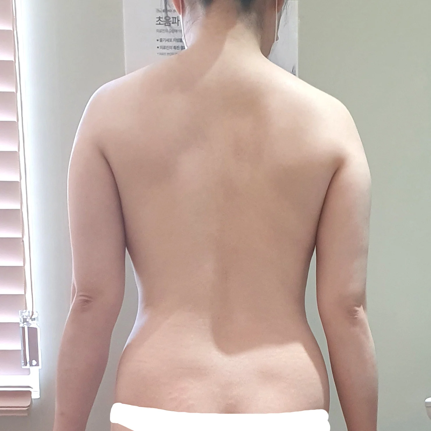 6-month post-op review~ - Other Liposuction Before 2 - TheLINE Plastic Surgery