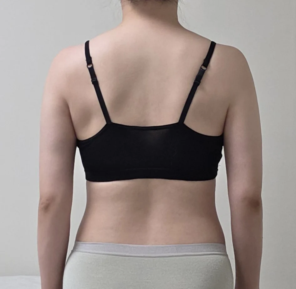 Posting my arm and accessory breast lipo - Arm Liposuction surgery After photo - TheLINE Plastic Surgery