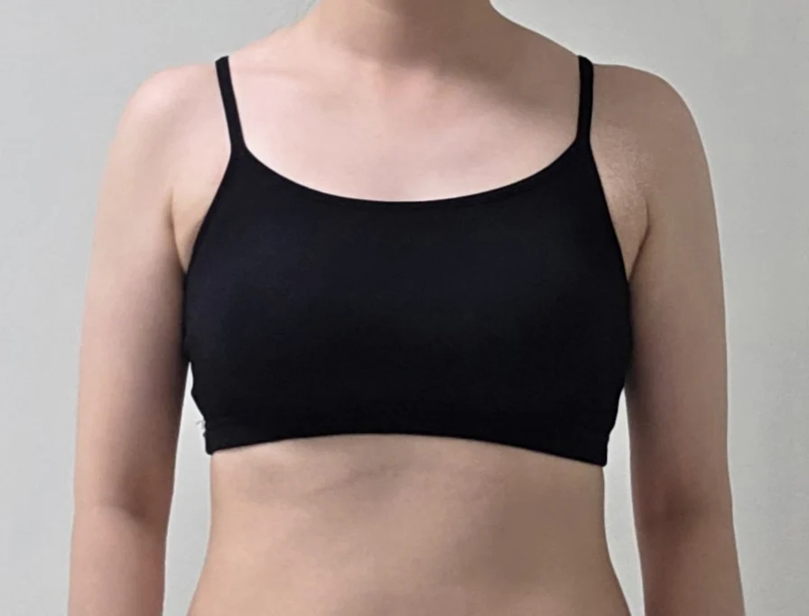 Posting my arm and accessory breast lipo - Arm Liposuction After 4 - TheLINE Plastic Surgery