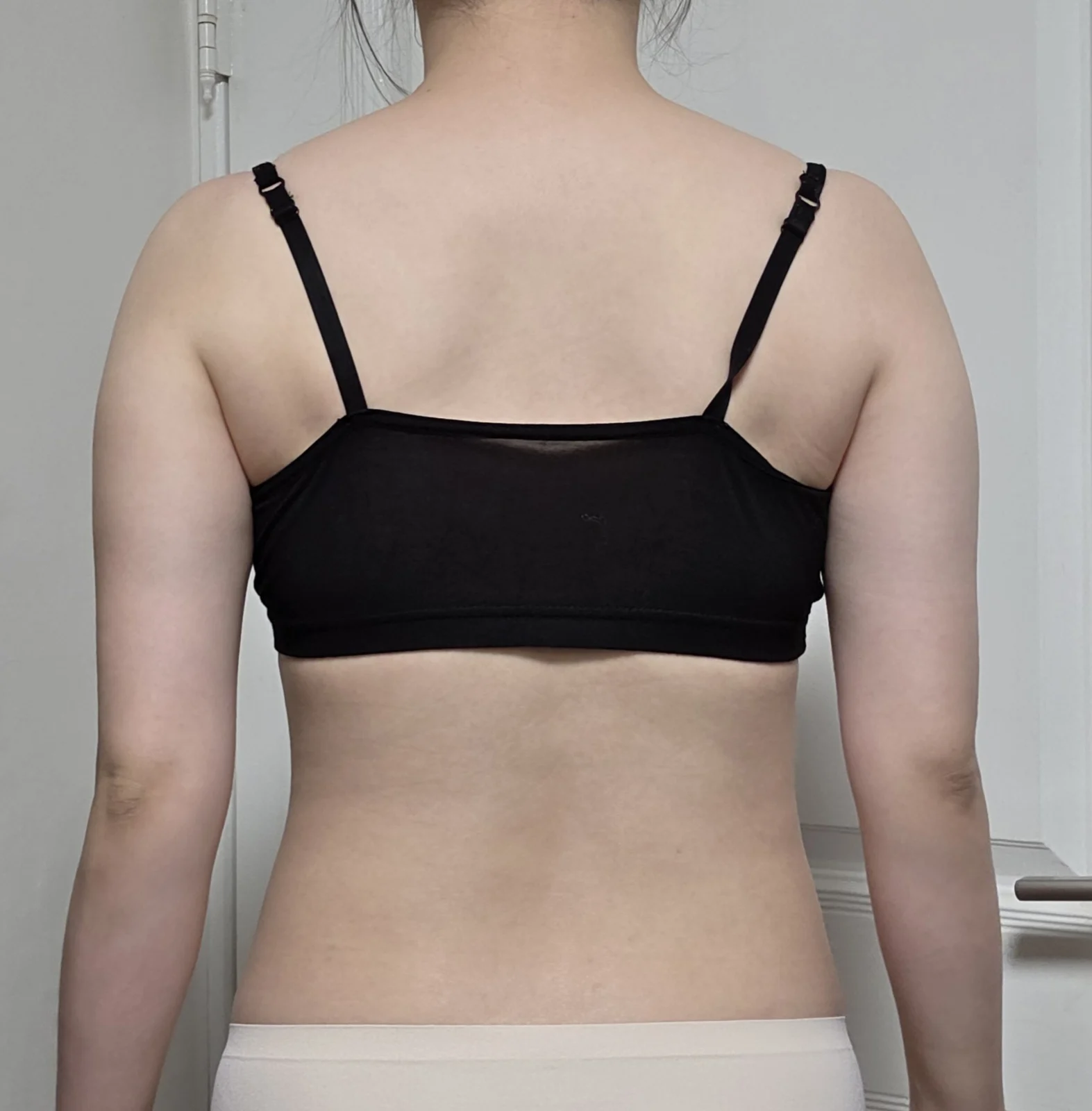 Posting my arm and accessory breast lipo - Arm Liposuction surgery Before photo - TheLINE Plastic Surgery