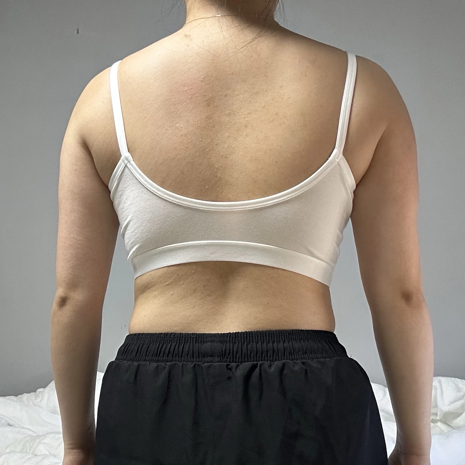 Arm liposuction, 3 months in!! - Arm Liposuction Before 2 - TheLINE Plastic Surgery