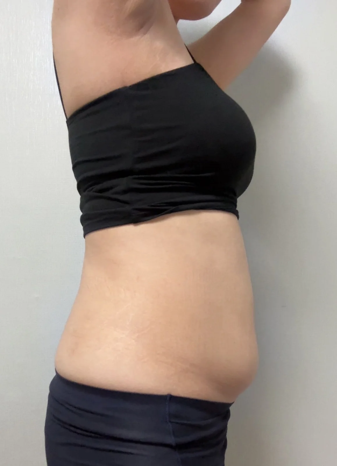 Abdomen and love handles, 6 months in~~ - Abdominal Liposuction (Upper Body) Before 2 - TheLINE Plastic Surgery