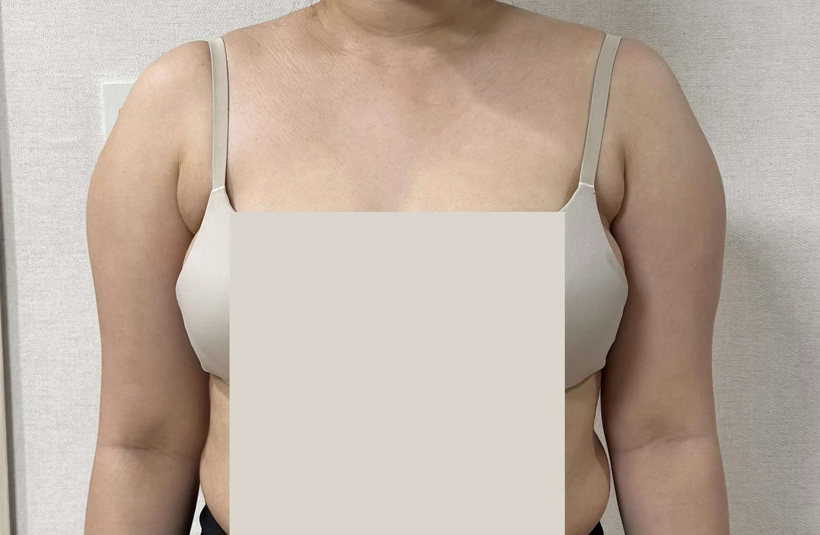 Arm liposuction before and after review  - Arm Liposuction Before 2 - TheLINE Plastic Surgery