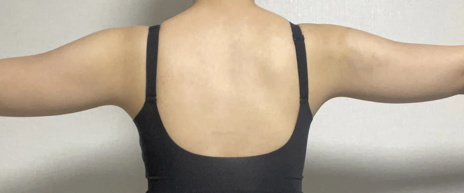 Arm liposuction, highly recommend! - Arm Liposuction Before 2 - TheLINE Plastic Surgery