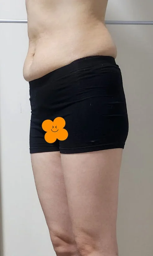 Abdomen and saddlebag liposuction plus b - Abdominal Liposuction (Upper Body) Before 2 - TheLINE Plastic Surgery