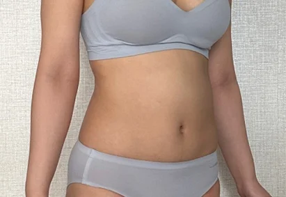 Posting my 3-month review~! - Abdominal Liposuction (Upper Body) Before 2 - TheLINE Plastic Surgery