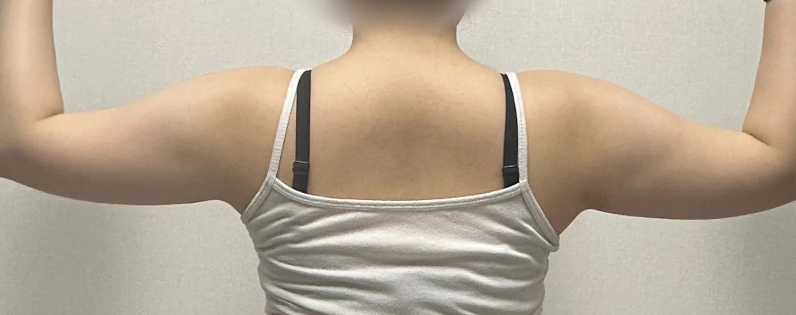 Upper arm liposuction review - Arm Liposuction Before 2 - TheLINE Plastic Surgery