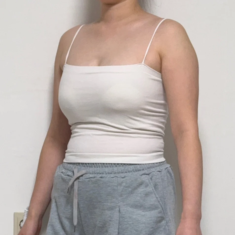 Arm and accessory breast surgery review~ - Arm Liposuction Before 2 - TheLINE Plastic Surgery