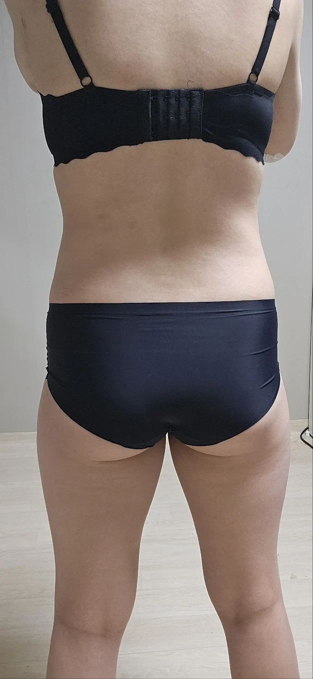 Liposuction and fat grafting review!! - Hip Fat Grafting Before 2 - TheLINE Plastic Surgery