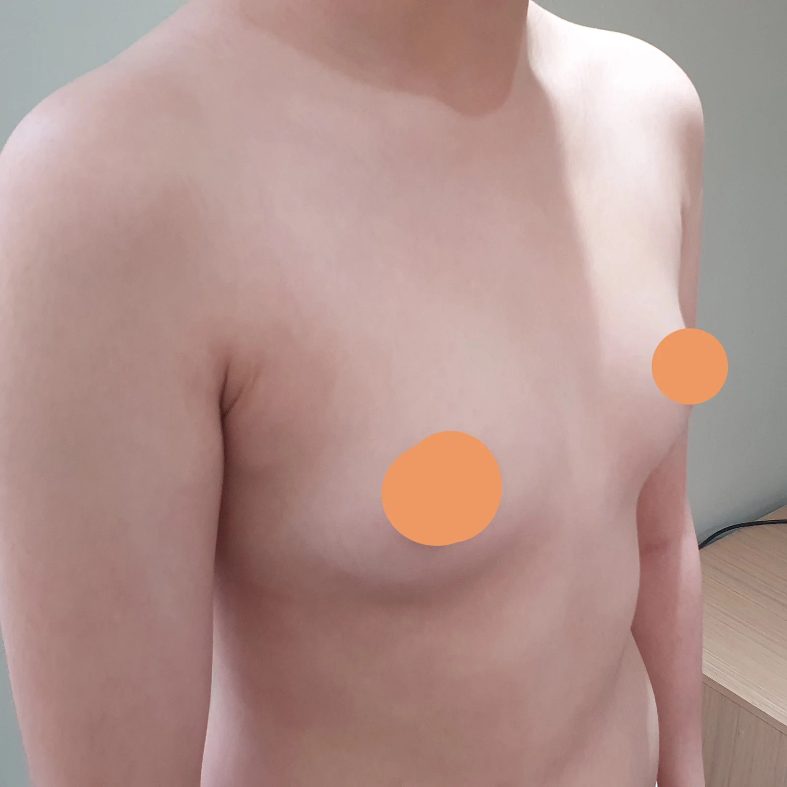 Breast fat grafting review, 4 months in - Breast Fat Grafting Before 2 - TheLINE Plastic Surgery