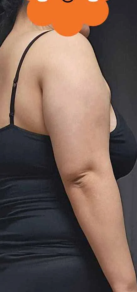Arm and accessory breast liposuction, 6  - Arm Liposuction Before 2 - TheLINE Plastic Surgery