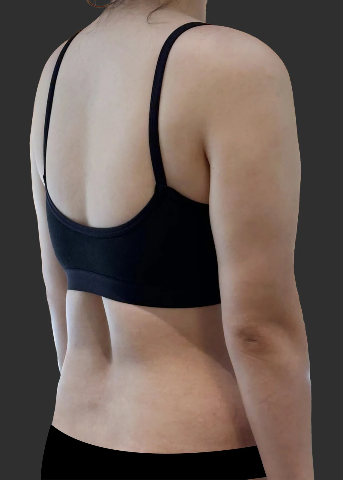 It has been a month since my stem cell a - Arm Liposuction Before 2 - TheLINE Plastic Surgery