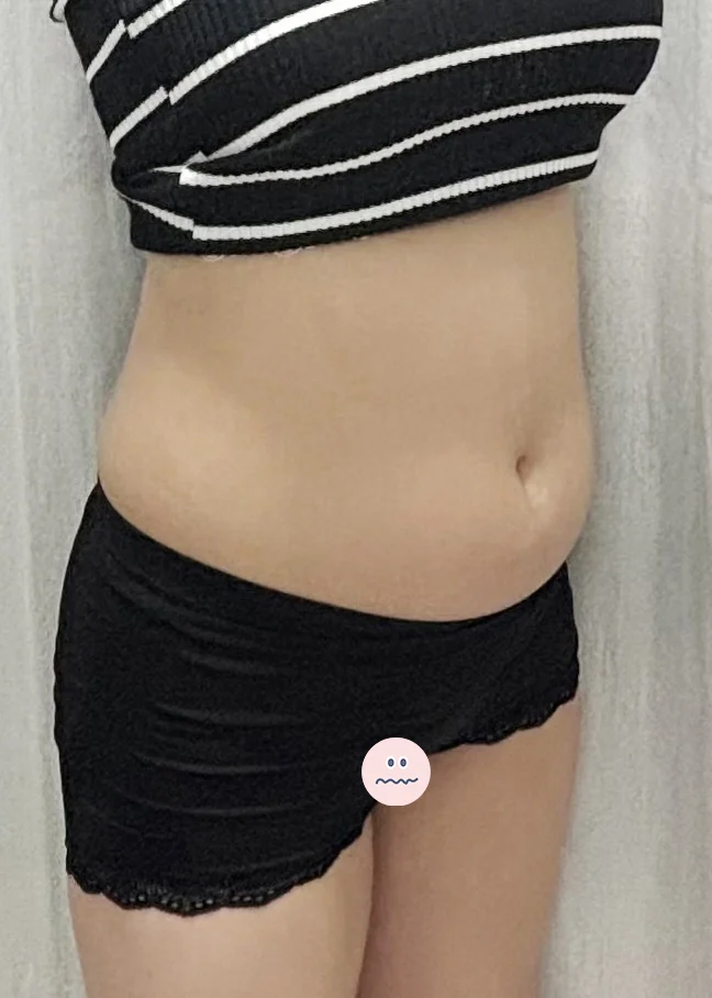 Six months after abdomen and hip dip sur - Hip Fat Grafting Before 2 - TheLINE Plastic Surgery