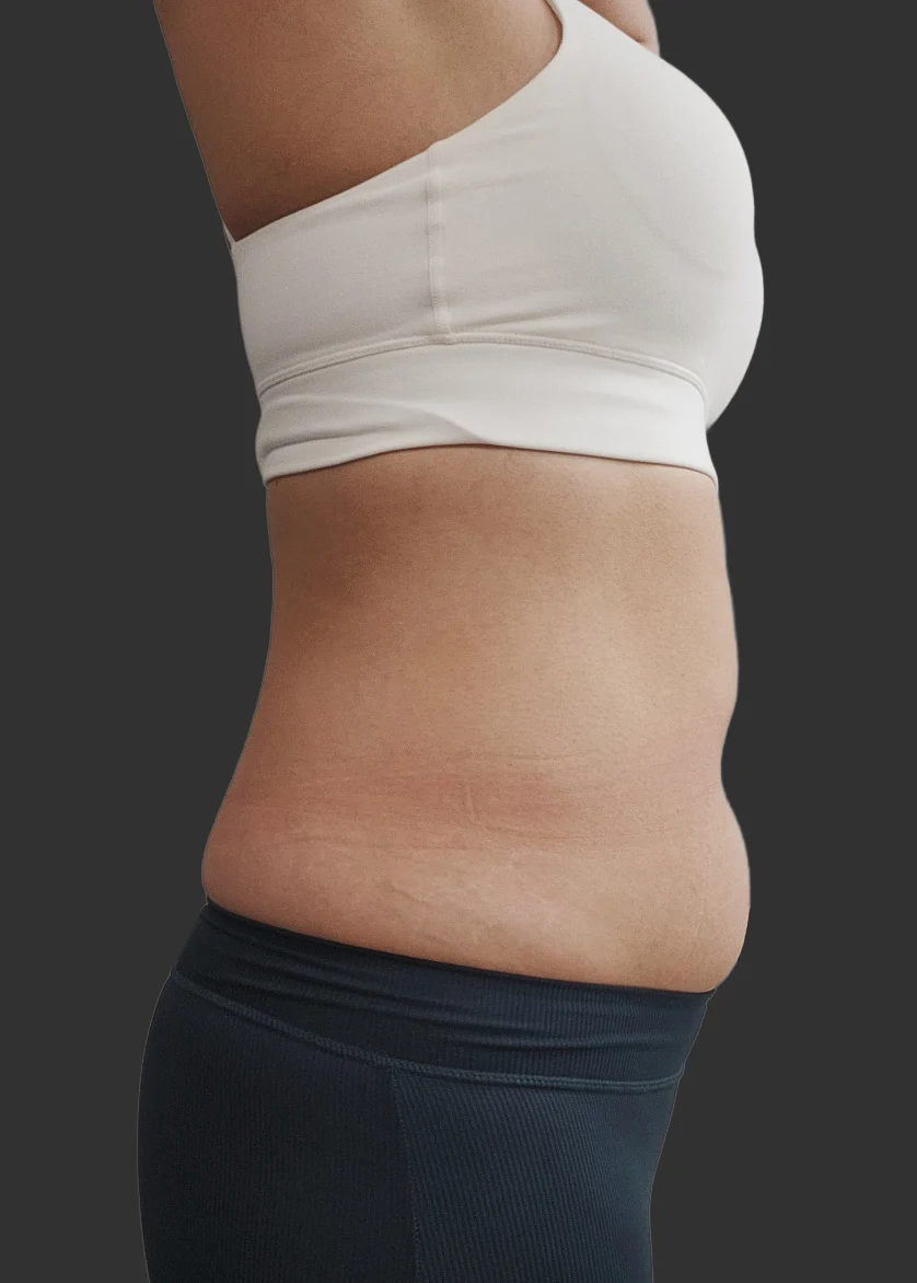 Posting my abdominal lipo review~ - Abdominal Liposuction (Upper Body) Before 2 - TheLINE Plastic Surgery
