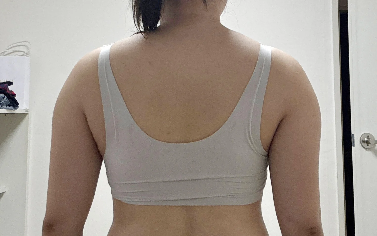 One month after arm lipo~!! - Arm Liposuction Before 2 - TheLINE Plastic Surgery