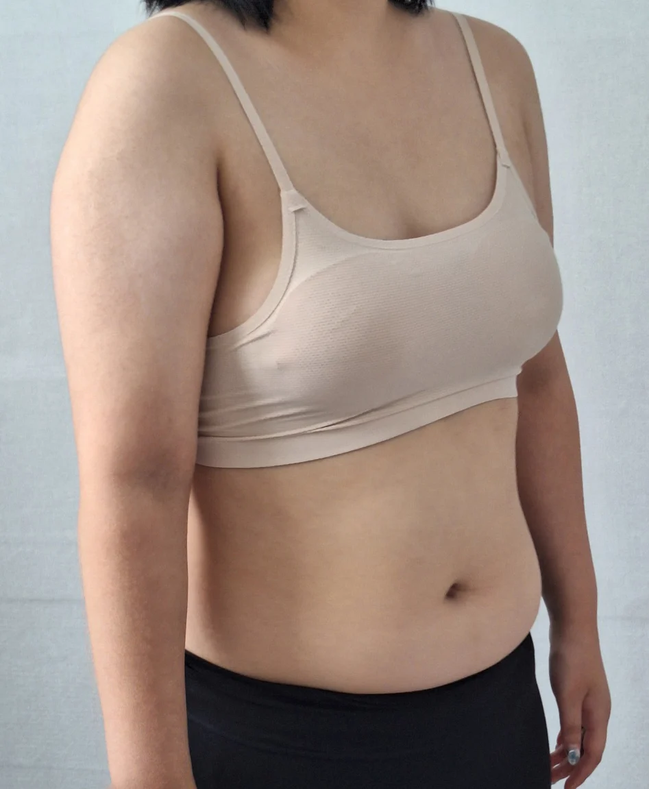 One-year review of arm + axillary breast - Arm Liposuction surgery Before photo - TheLINE Plastic Surgery