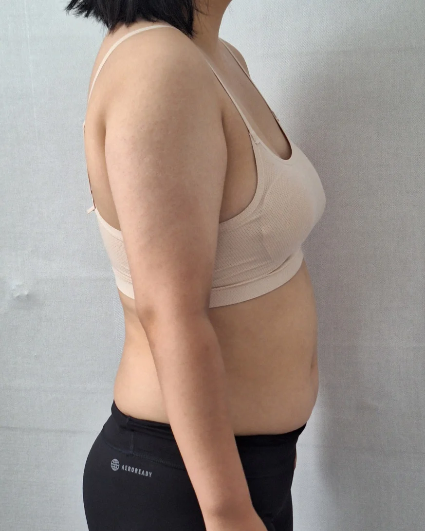 One-year review of arm + axillary breast - Arm Liposuction Before 2 - TheLINE Plastic Surgery