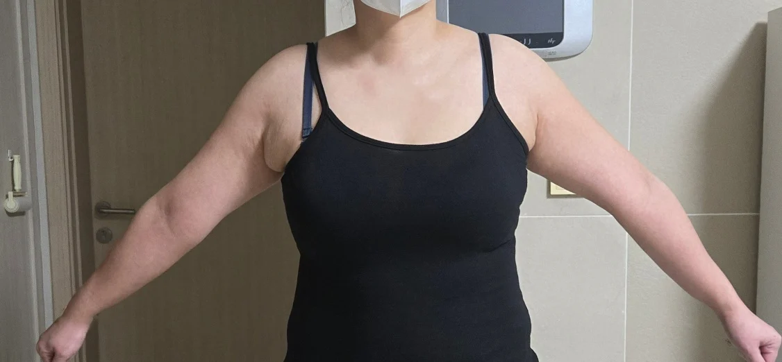 Three months have passed - Arm Liposuction Before 2 - TheLINE Plastic Surgery