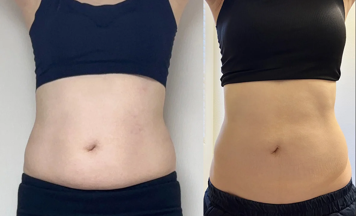 Six months after abdominal liposuction - Abdominal Liposuction (Upper Body) Before 2 - TheLINE Plastic Surgery