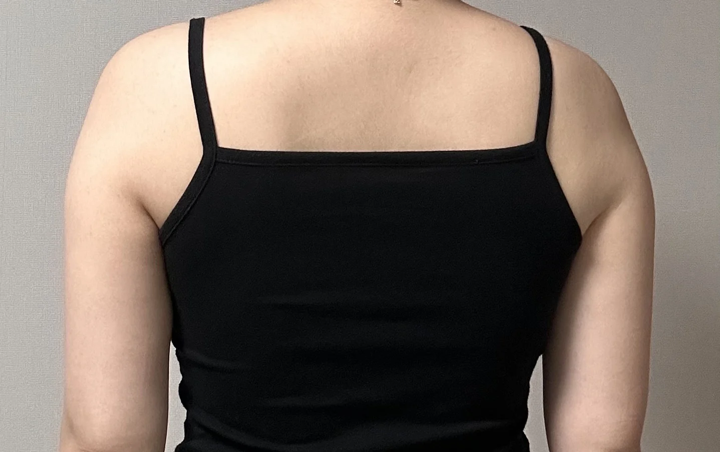 One-month review of upper arm and axilla - Arm Liposuction Before 2 - TheLINE Plastic Surgery