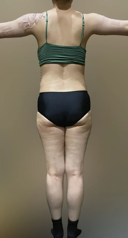 Full-body liposuction + grafting (Dr. Yo - Arm Liposuction Before 2 - TheLINE Plastic Surgery