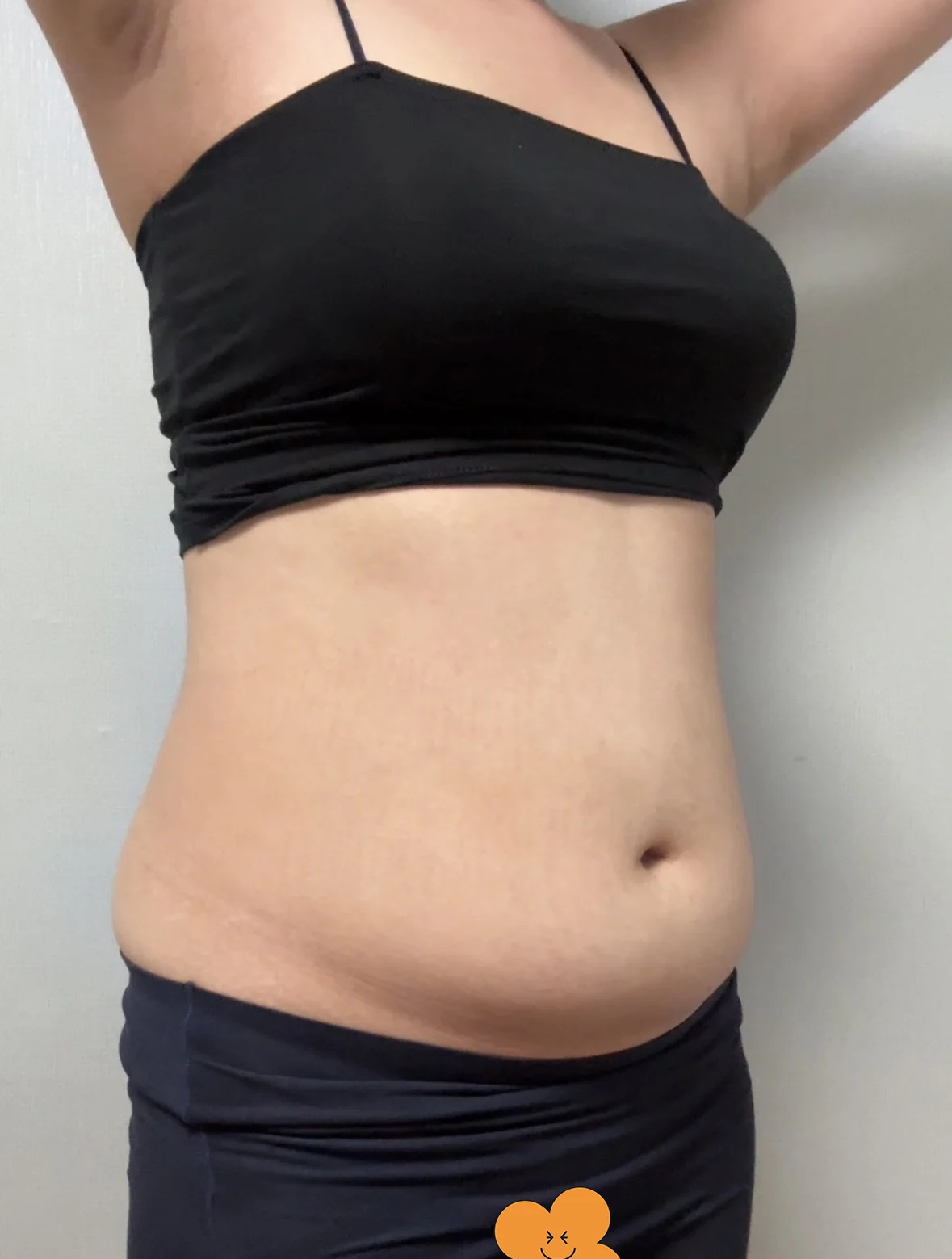 Abdominal lipo review! - Abdominal Liposuction (Upper Body) Before 2 - TheLINE Plastic Surgery