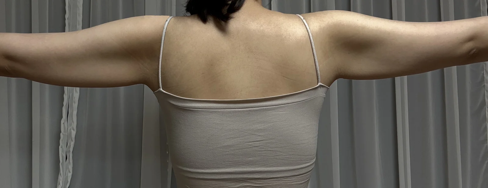 One month after arm lift + arm liposucti - Body Contouring Before 2 - TheLINE Plastic Surgery