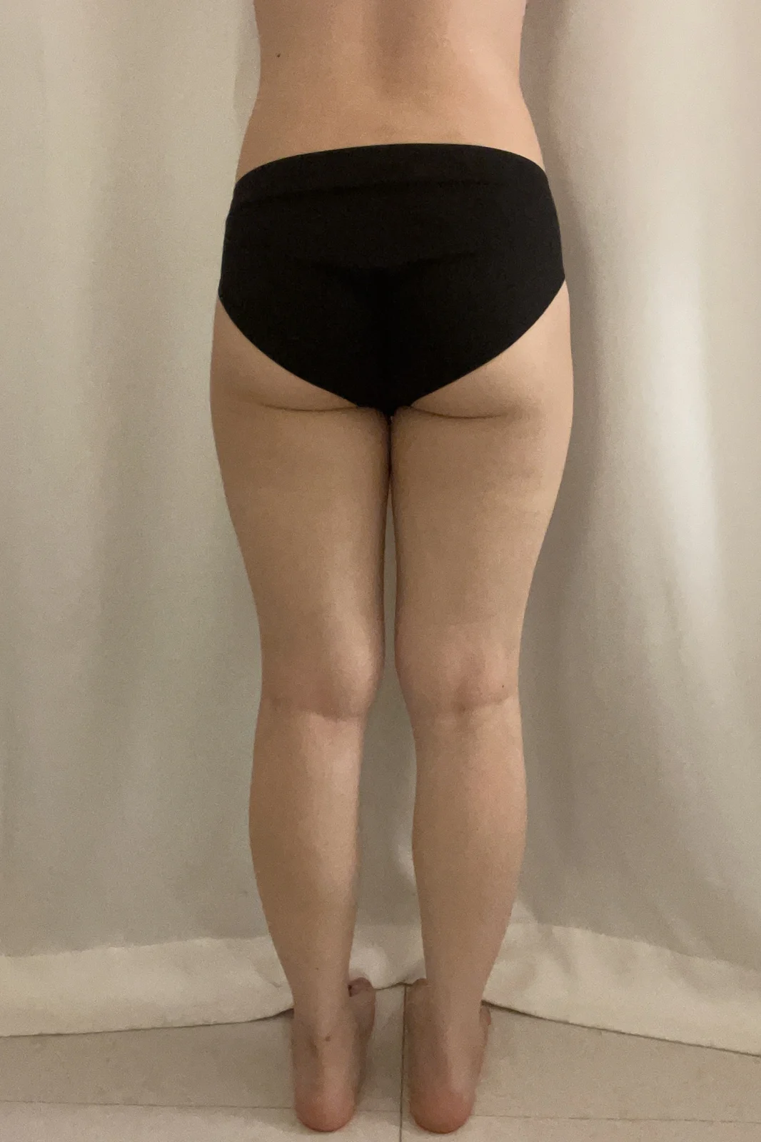 Three-month review~ - Thigh Liposuction (Lower Body) surgery Before photo - TheLINE Plastic Surgery