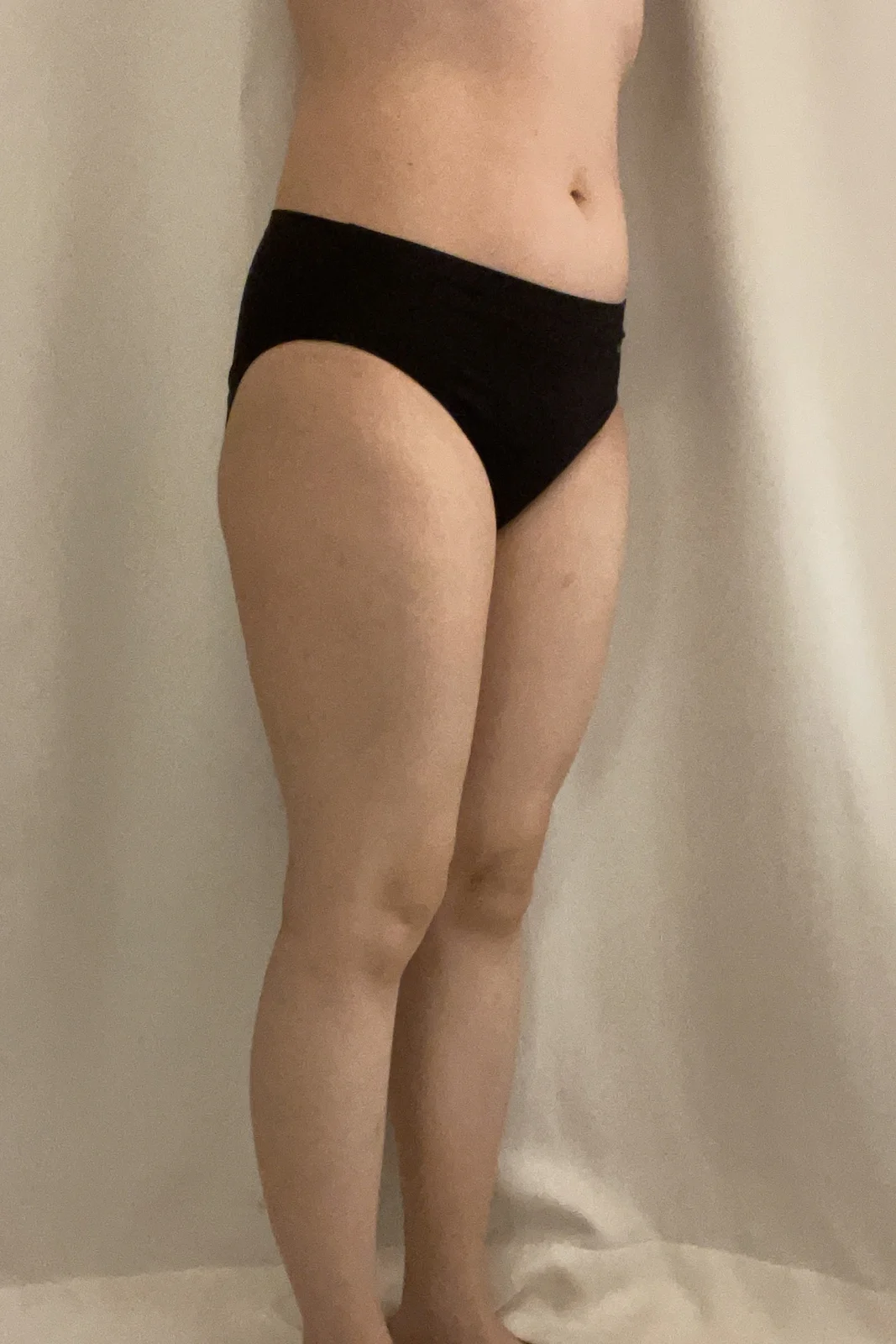 Three-month review~ - Thigh Liposuction (Lower Body) Before 2 - TheLINE Plastic Surgery