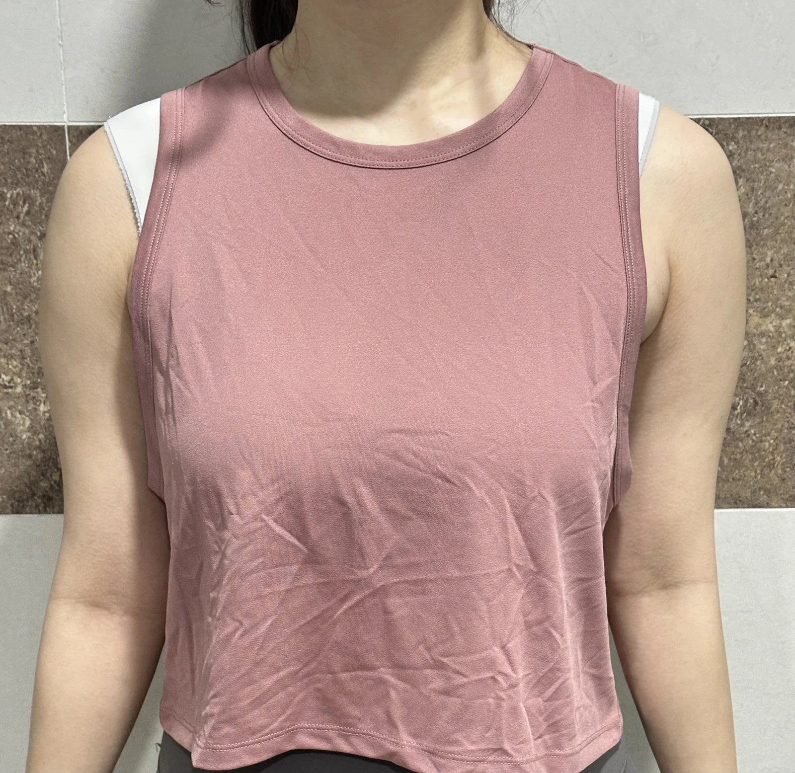 Six months after upper arm & axillary br - Arm Liposuction Before 2 - TheLINE Plastic Surgery
