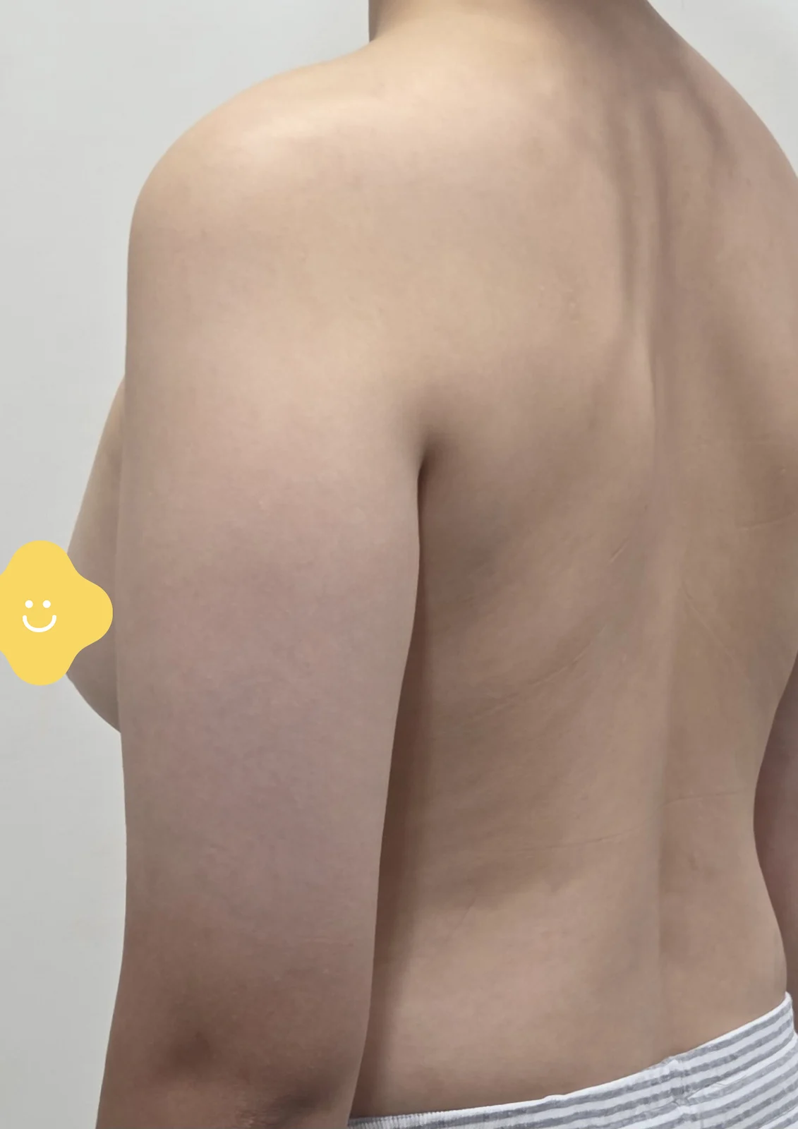 Upper arm liposuction, 100% satisfied - Arm Liposuction Before 2 - TheLINE Plastic Surgery