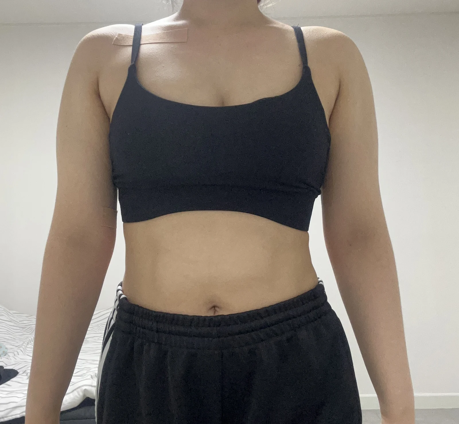 One-month review of arm and axillary bre - Arm Liposuction Before 2 - TheLINE Plastic Surgery