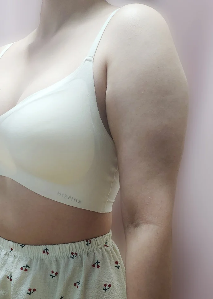 One month after arm liposuction!! - Arm Liposuction Before 2 - TheLINE Plastic Surgery