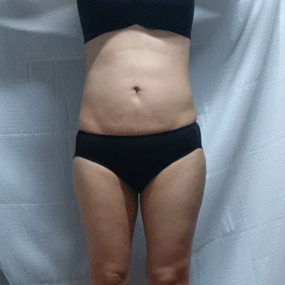 Highly recommend TheLINE!! - Hip Fat Grafting Before 2 - TheLINE Plastic Surgery