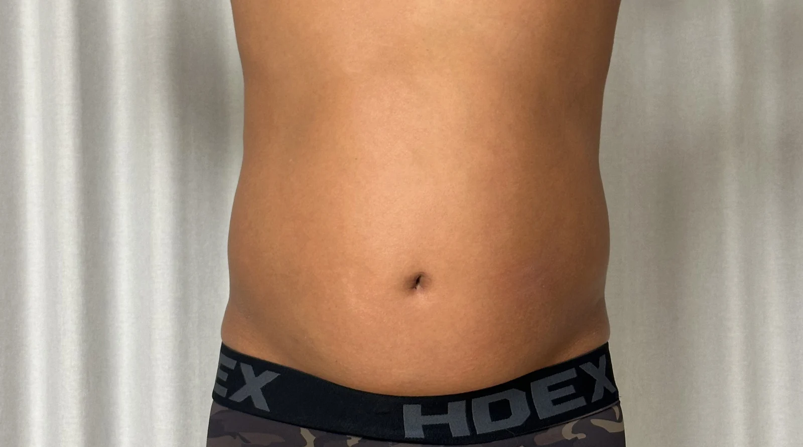 I am satisfied with my abdominal liposuc - Abdominal Liposuction (Upper Body) Before 2 - TheLINE Plastic Surgery