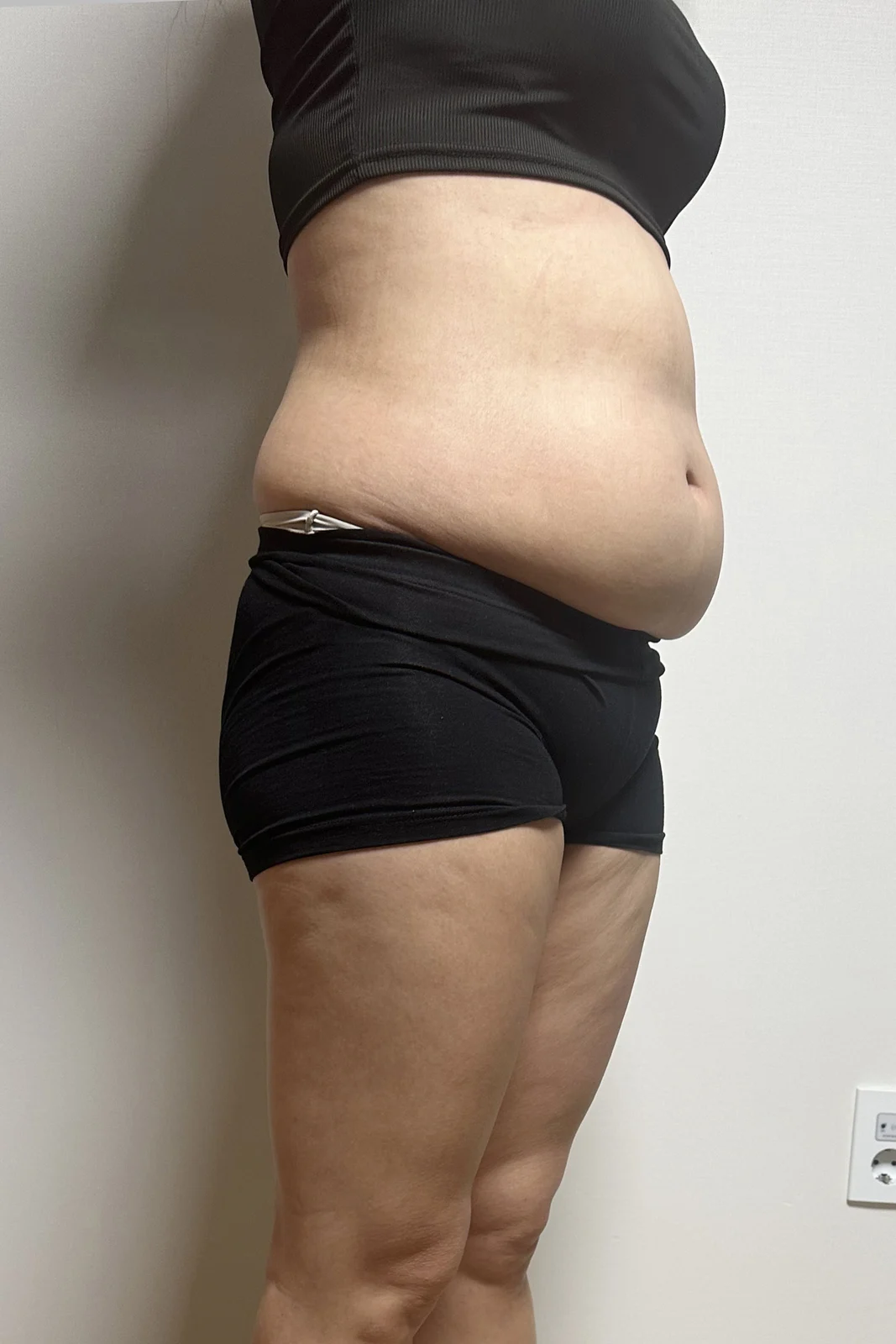 One-month abdomen review - Abdominal Liposuction (Upper Body) Before 2 - TheLINE Plastic Surgery
