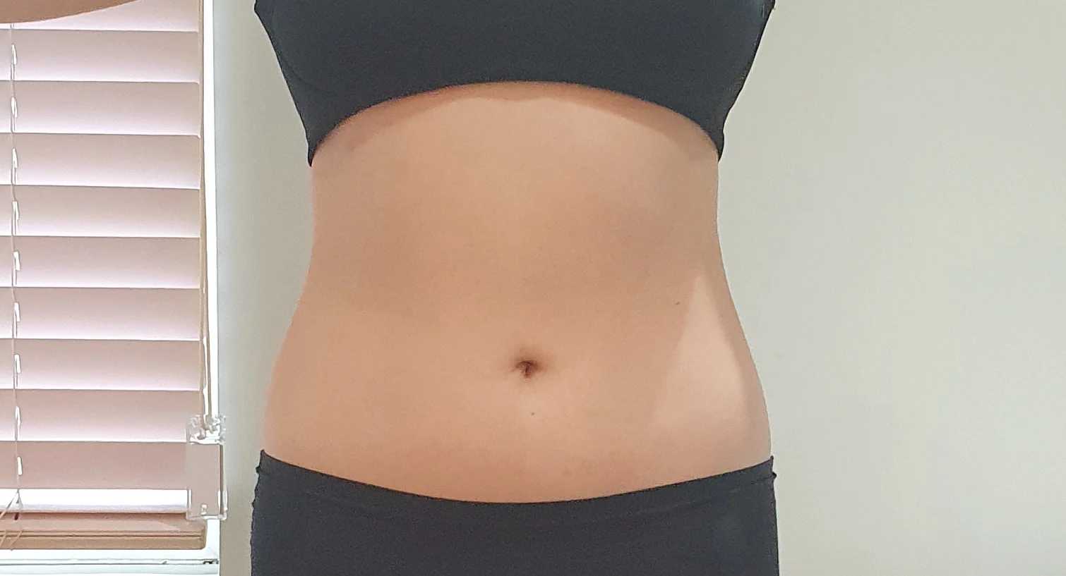 Looking forward to what comes next~~ - Hip Fat Grafting Before 2 - TheLINE Plastic Surgery