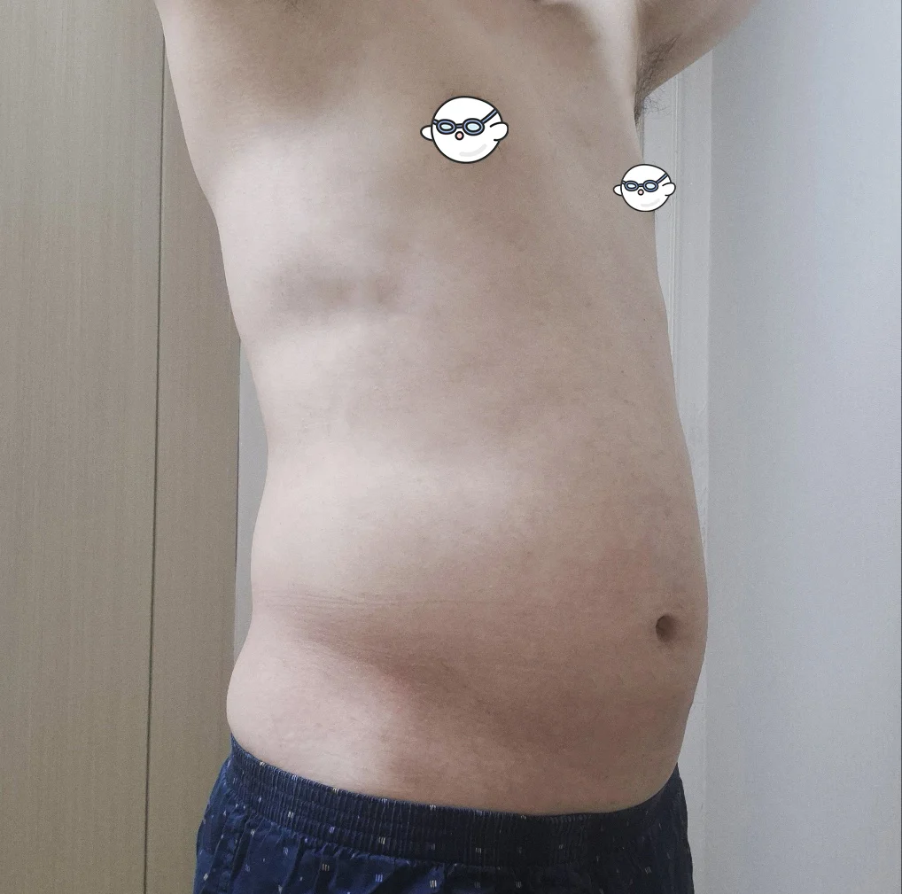 Thank you, Dr. Jaeho Cho - Facial Liposuction surgery Before photo - TheLINE Plastic Surgery