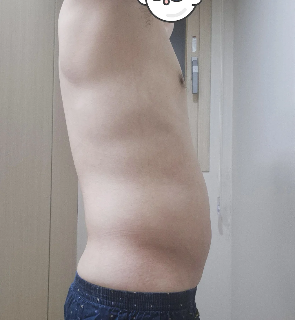 Thank you, Dr. Jaeho Cho - Facial Liposuction Before 2 - TheLINE Plastic Surgery