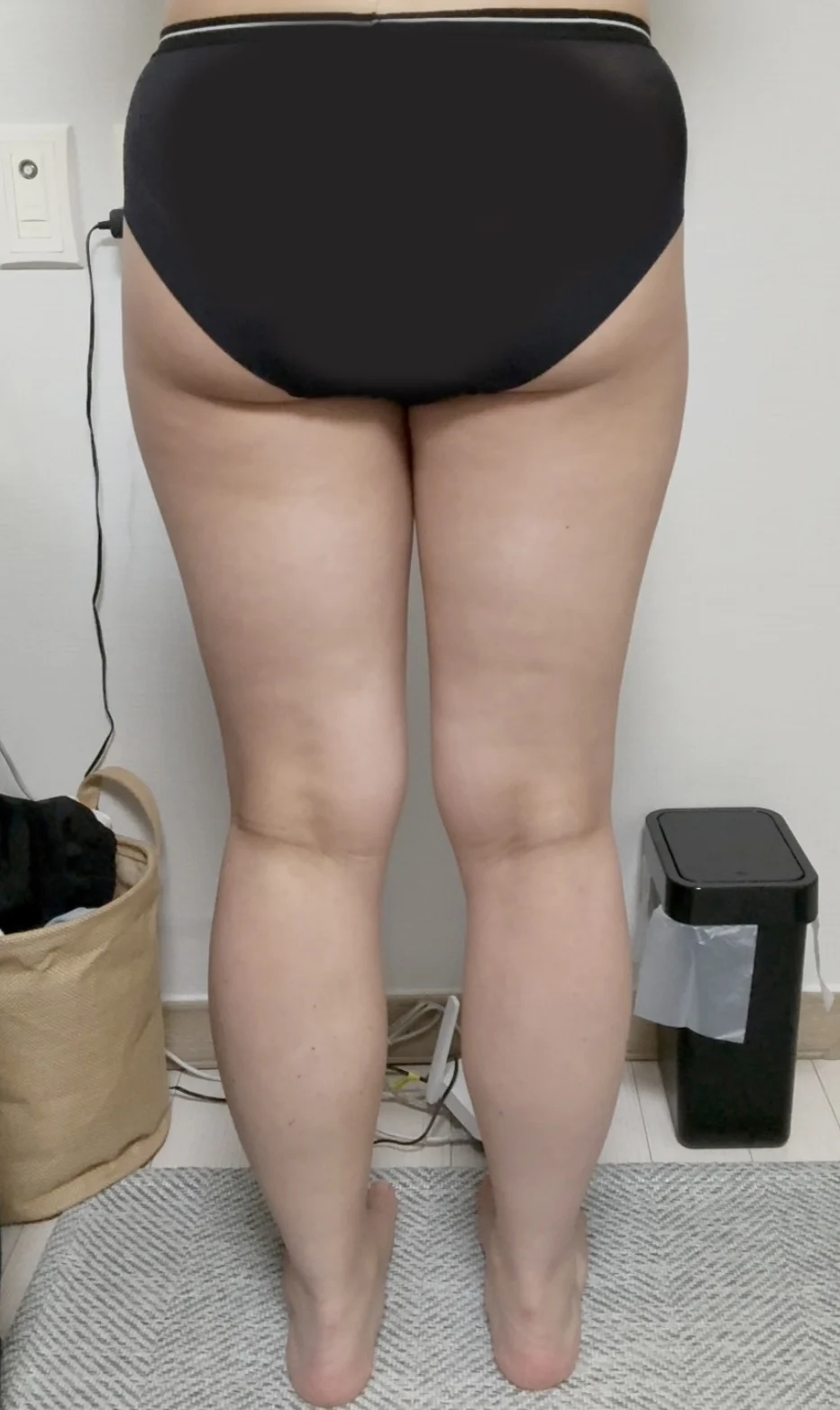Thigh, Chanel line, hip graft at six mon - Thigh Liposuction (Lower Body) Before 2 - TheLINE Plastic Surgery