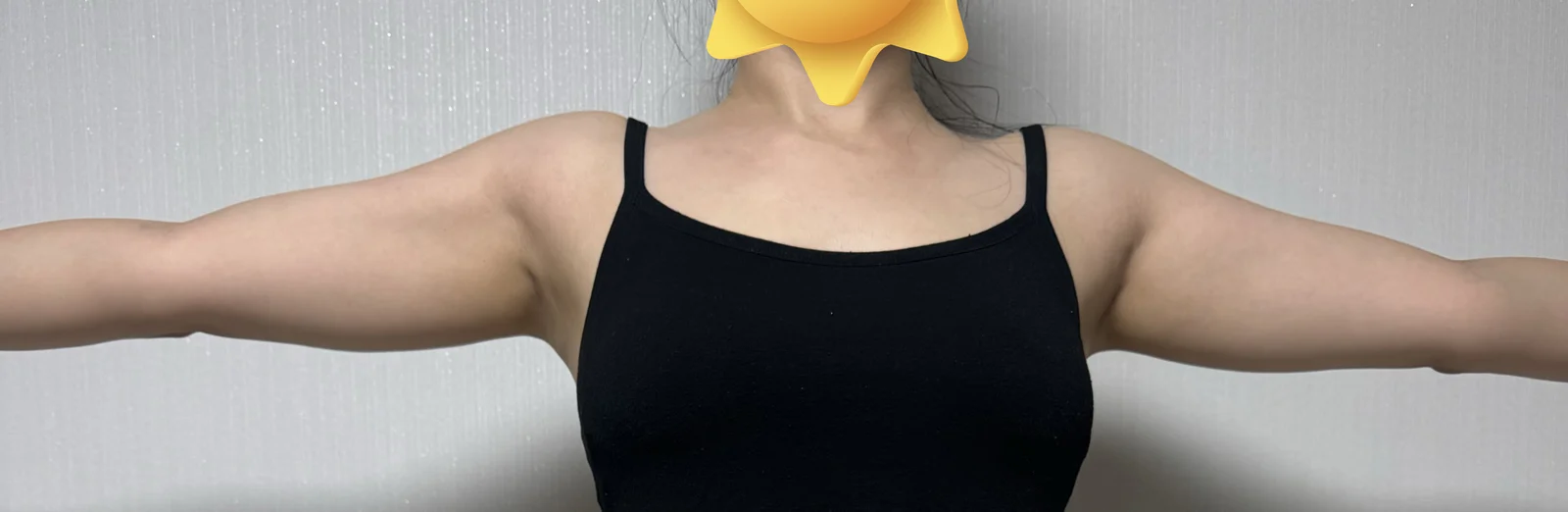 Arm + back root liposuction, 6-month cha - Arm Liposuction Before 2 - TheLINE Plastic Surgery