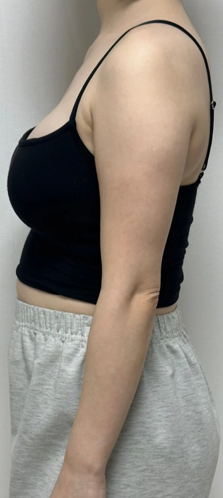 Arm + abdomen lipo review - Arm Liposuction Before 2 - TheLINE Plastic Surgery