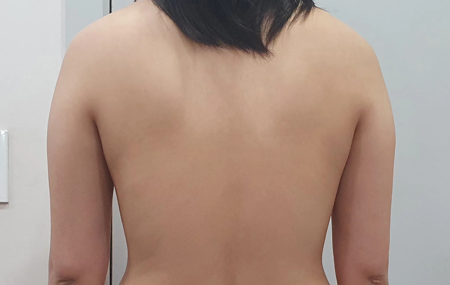 Six-month review - Arm Liposuction surgery Before photo - TheLINE Plastic Surgery