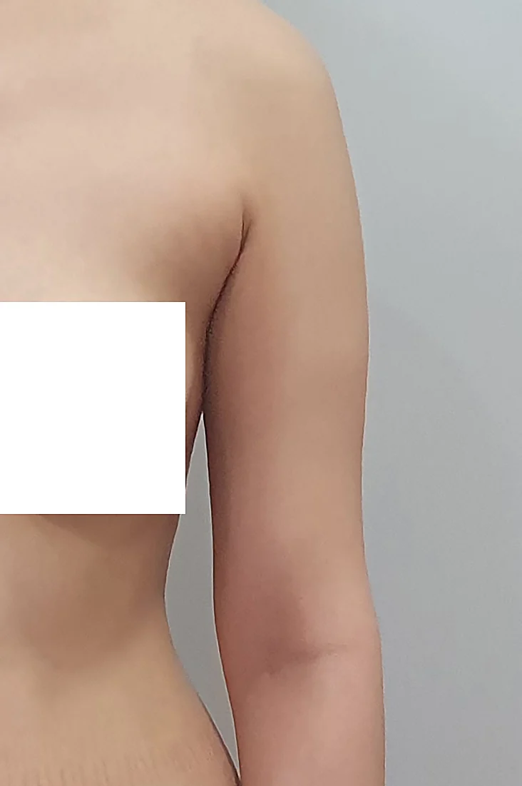 Six-month review - Arm Liposuction Before 2 - TheLINE Plastic Surgery