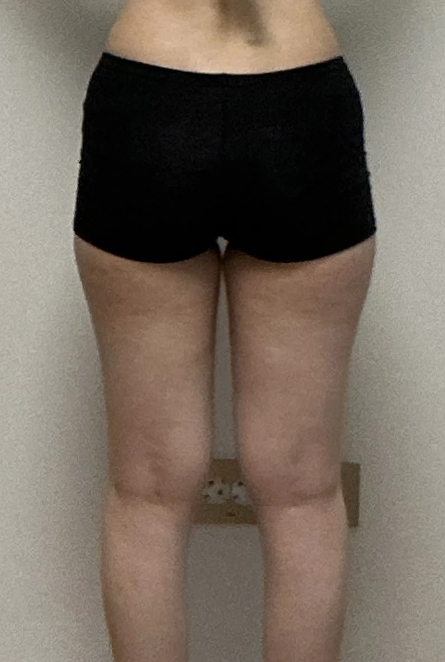 Thigh and hip dip fat grafting review - Hip Fat Grafting Before 2 - TheLINE Plastic Surgery